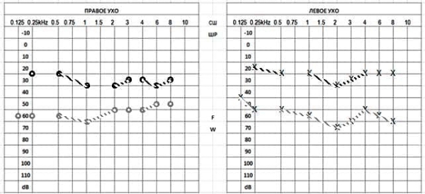 
        Клинический случай семейного отосклероза                    