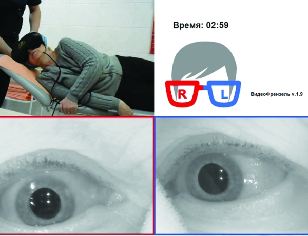 Доброкачественное позиционное пароксизмальное головокружение
Доброкачественное позиционное пароксизмальное головокружение