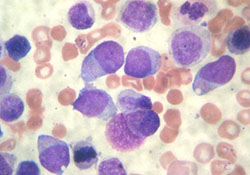 
        Острый миелоидный лейкоз у детей			    