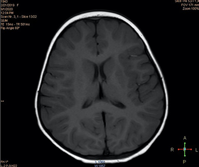 Пароксизмальные состояния у детей неэпилептического характера
Пароксизмальные состояния у детей неэпилептического характера