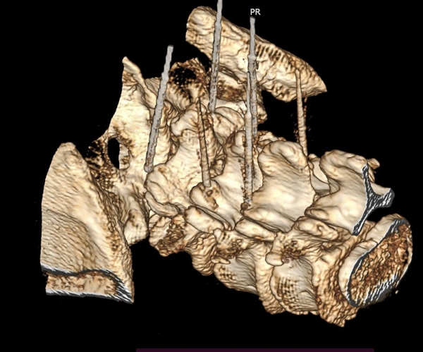 Фасеточный синдром: радиочастотная денервация фасеточных суставов
Фасеточный синдром: радиочастотная денервация фасеточных суставов