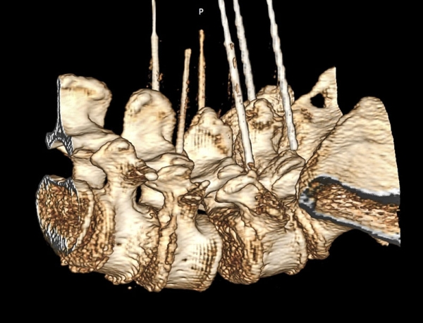 Фасеточный синдром: радиочастотная денервация фасеточных суставов
Фасеточный синдром: радиочастотная денервация фасеточных суставов