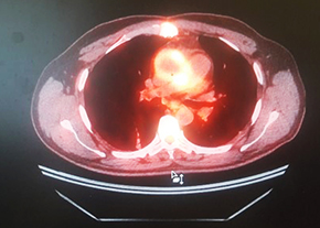 
        ПЭТ в диагностике воспалительных изменений после кардиохирургических вмешательств			    