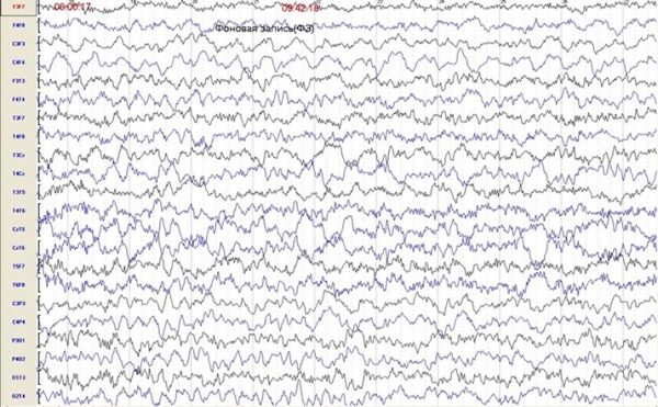 Пароксизмальные состояния у детей неэпилептического характера
Пароксизмальные состояния у детей неэпилептического характера