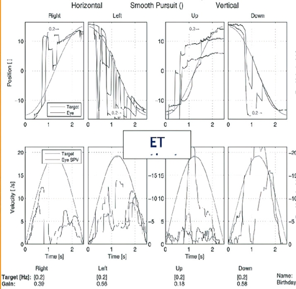 Периферический вестибулярный синдром
Периферический вестибулярный синдром