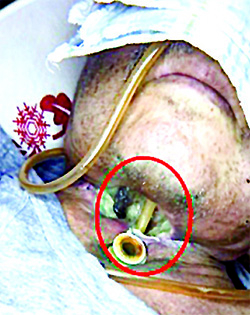 
        Онкологические заболевания гортани. Еще раз о важности регулярного наблюдения у профильных специалистов			    