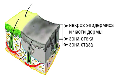 
        Ожоги: принципы диагностики и выбор тактики лечения. Часть 1			    