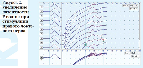 
        Хроническая воспалительная  демиелинизирующая полиневропатия с острым началом у беременной			    