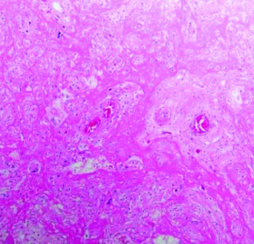 Патология плаценты при COVID-19
Патология плаценты при COVID-19