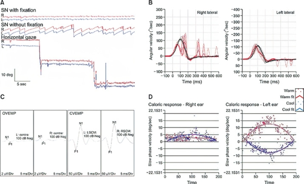 Периферический вестибулярный синдром
Периферический вестибулярный синдром