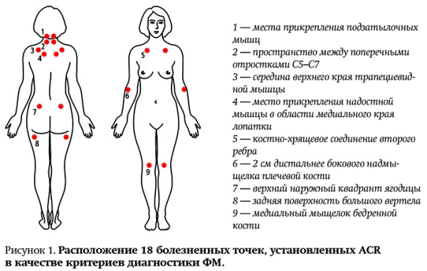 
        Современные аспекты диагностики и лечения фибромиалгии			    