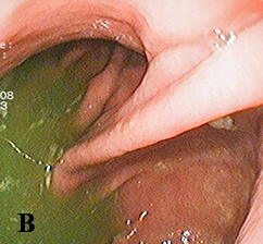 Халитоз: от симптома к диагнозу и терапии
Халитоз: от симптома к диагнозу и терапии