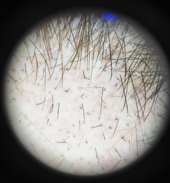 COVID-19 и выпадение волос
COVID-19 и выпадение волос