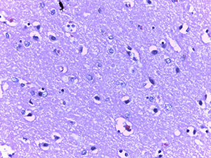 Патоморфологические изменения головного мозга при COVID-19
Патоморфологические изменения головного мозга при COVID-19