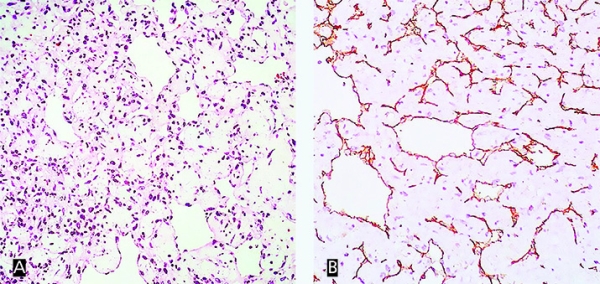 Опухоль в сердце: сложности диагностики и хирургии
Опухоль в сердце: сложности диагностики и хирургии