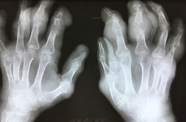 
        В капкане подагры			    