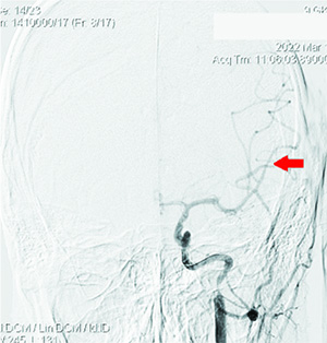 
        Острый ишемический инсульт у подростка: опыт комбинированного внутрисосудистого тромболизиса			    