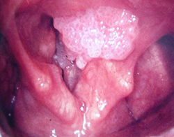 Предраковые заболевания гортани
Предраковые заболевания гортани