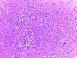 Патоморфологические изменения головного мозга при COVID-19
Патоморфологические изменения головного мозга при COVID-19