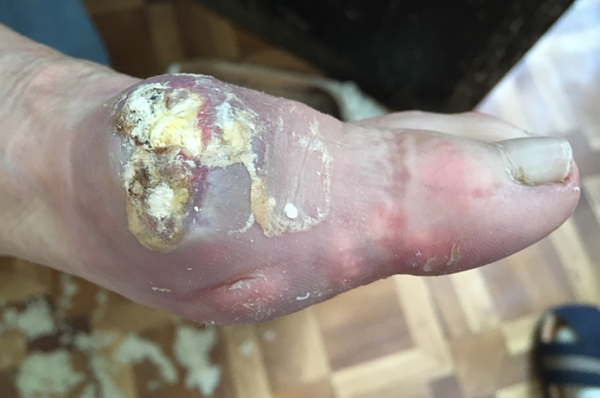 
        В капкане подагры			    