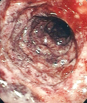 Острая гастродуоденальная боль. Часть 2
Острая гастродуоденальная боль. Часть 2
