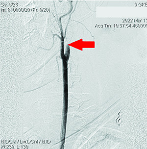 
        Острый ишемический инсульт у подростка: опыт комбинированного внутрисосудистого тромболизиса			    