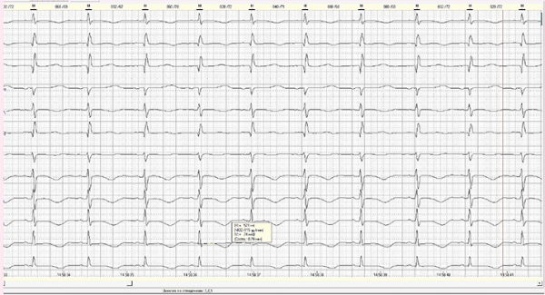 
        Диагностика врожденного синдрома  удлиненного интервала QT			    