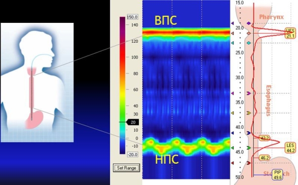 Манометрия пищевода высокого разрешения			     
        Манометрия пищевода высокого разрешения