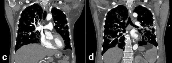 
        Пневмония COVID-19 и ТЭЛА			    