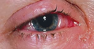 Возвращение туляремии…Что следующее?
Возвращение туляремии…Что следующее?