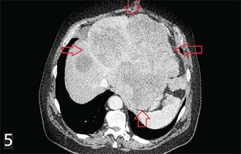 
        Гастроинтестинальные стромальные опухоли: взгляд рентгенолога			    