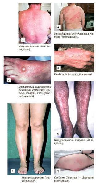 
        Важные вопросы лекарственной гиперчувствительности			    