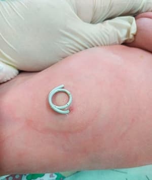 
        Обструкция верхних отделов мочевыводящей системы у плода. Клинический случай			    