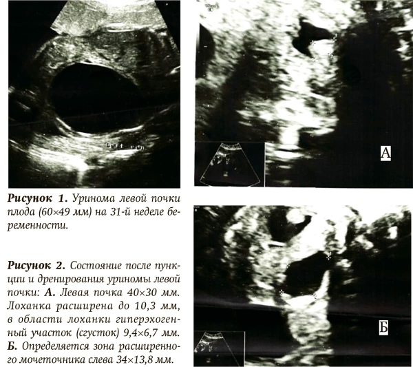 
        Обструкция верхних отделов мочевыводящей системы у плода. Клинический случай			    