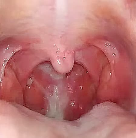 Ребенок с лор-патологией на приеме у ВОП и педиатра
Ребенок с лор-патологией на приеме у ВОП и педиатра