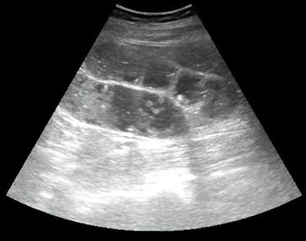 
        Алгоритм ультразвуковой диагностики острого аппендицита			    