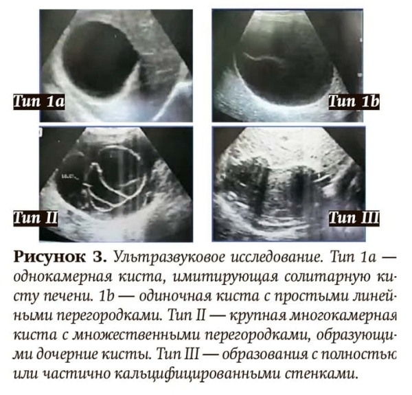 
        Эхинококкоз: как избежать послеоперационных рецидивов			    