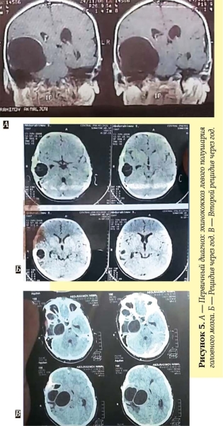
        Эхинококкоз: как избежать послеоперационных рецидивов			    