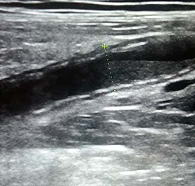 
        Алгоритм ультразвуковой диагностики острого аппендицита			    