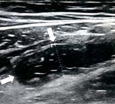 
        Алгоритм ультразвуковой диагностики острого аппендицита			    