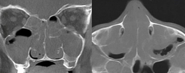 
        Состояние лор-органов у пациентов детского возраста с муковисцидозом			    