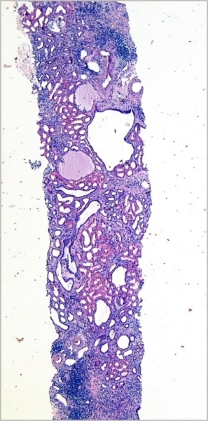 
        Морфологическая диагностика в детской нефрологии			    