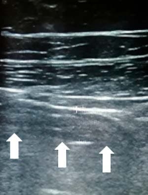 
        Алгоритм ультразвуковой диагностики острого аппендицита			    
