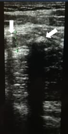
        Алгоритм ультразвуковой диагностики острого аппендицита			    