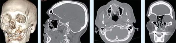 
        Постковидные остеонекрозы костей лицевого отдела черепа			    