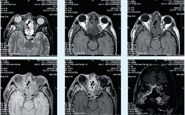 
        Постковидные остеонекрозы костей лицевого отдела черепа			    