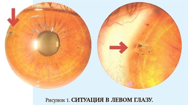 Внутриглазная миграция металлического инородного тела			     
        Внутриглазная миграция металлического инородного тела