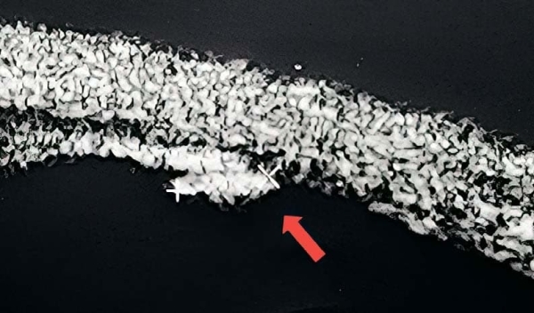 Внутриглазная миграция металлического инородного тела			     
        Внутриглазная миграция металлического инородного тела