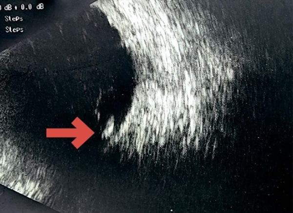 Внутриглазная миграция металлического инородного тела			     
        Внутриглазная миграция металлического инородного тела