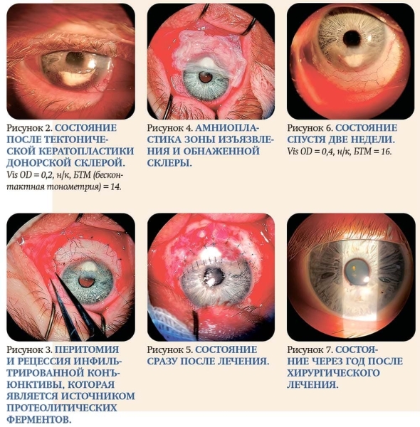 Хирургическое лечение периферических язв роговицы			     
        Хирургическое лечение периферических язв роговицы